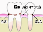 歯周病・歯槽膿漏2　歯肉炎